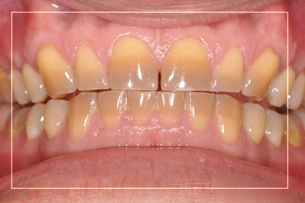 rang nhiem tetracycline 1