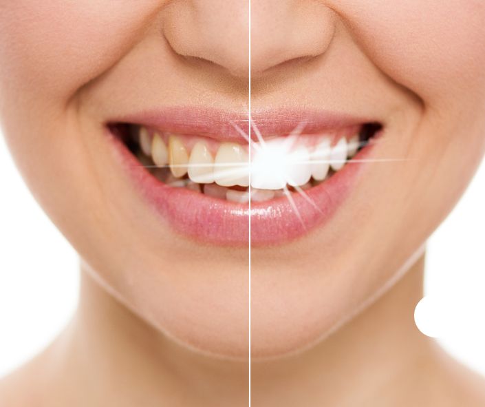 whitening teeth service cost